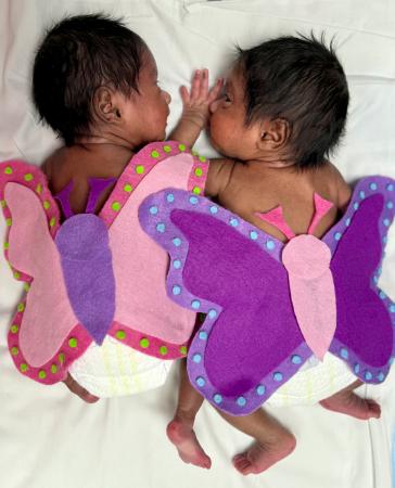 Baby Mitha & Mithu, Baylor Scott & White Medical Center – Frisco at PGA Parkway