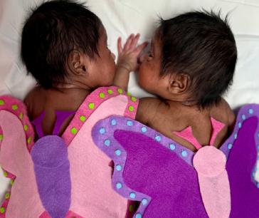 Baby Mitha & Mithu, Baylor Scott & White Medical Center – Frisco at PGA Parkway